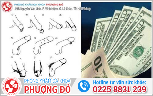 Chi phí gắn bi phù hợp với điều kiện kinh tế của nam giới