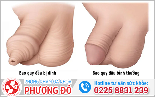 Hình ảnh dính bao quy đầu của người trưởng thành