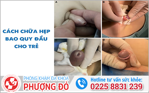 Cách xử lý khi trẻ bị dính bao quy đầu 