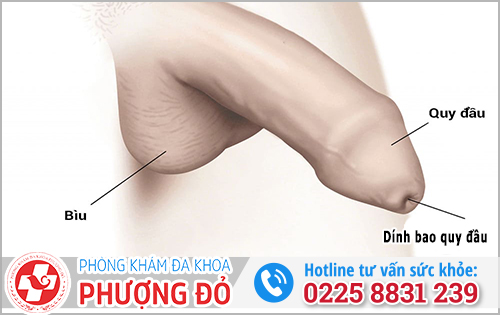 Nguyên nhân bị dính bao quy đầu