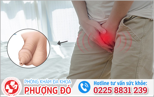 Dính bao quy đầu có sao không?