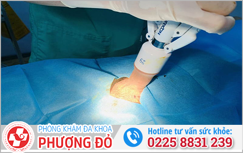 Cắt bao quy đầu bị dính