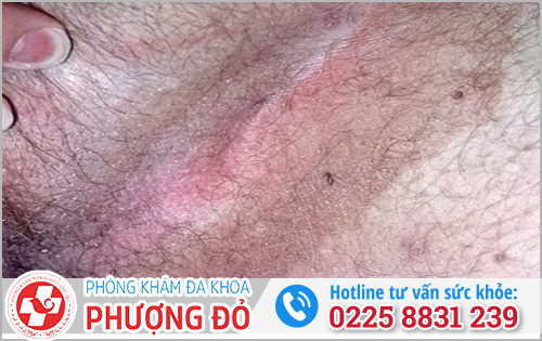 Dị ứng - Nguyên nhân làm cho dương vật chảy mủ
