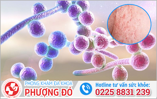 Nấm Candida khiến dương vật bị chảy mủ