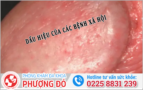 Đầu dương vật nổi mụn đỏ ngứa