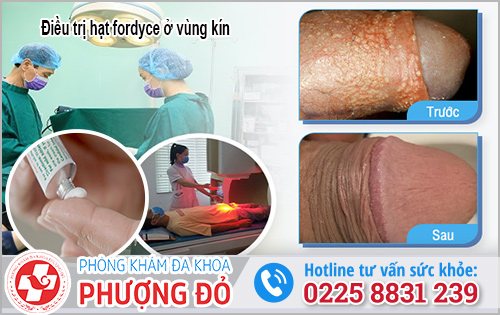 Cách điều trị hạt fordyce ở vùng kín