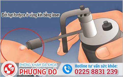 Điều trị hạt fordyce ở vùng kín bằng laser