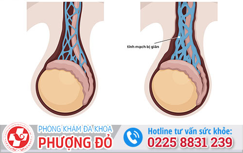 Những nguyên nhân gây giãn tĩnh mạch thừng tinh