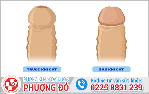 Trước và sau khi cắt bao quy đầu bị hẹp