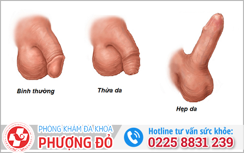 Nếu không cắt hẹp bao quy đầu có sao không?