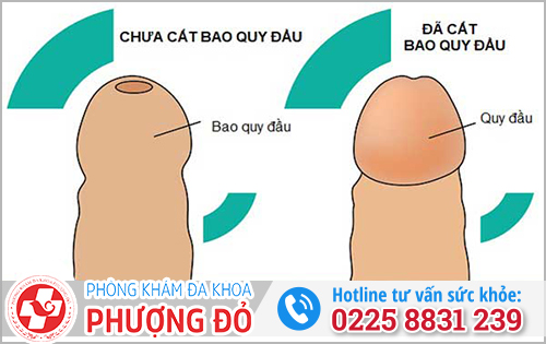 Hẹp bao quy đầu trước và sau khi cắt