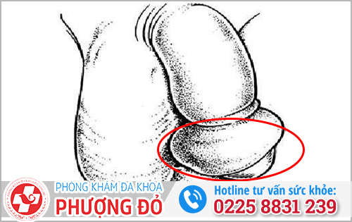 Hẹp bao quy đầu gây sưng phù nề