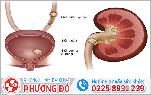 Buồn tiểu liên tục nhưng tiểu ít do có sỏi