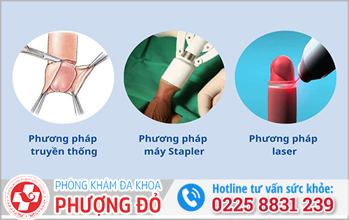 40 tuổi nên cắt bao quy đầu bằng phương pháp nào?