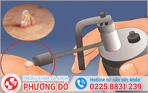 Phương pháp xử lý hạt ngọc dương vật