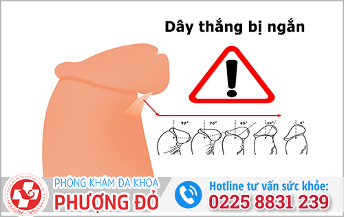 Ngắn dây hãm bao quy đầu