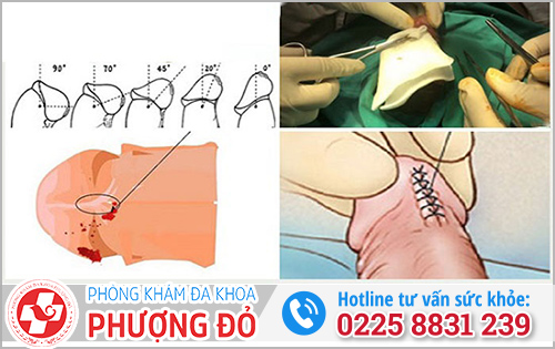 Cách xử lý dây thắng bao quy đầu ngắn