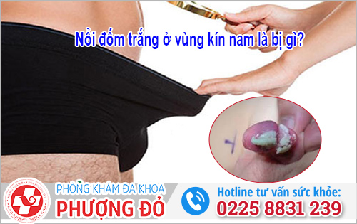 Nổi đốm trắng ở vùng kín nam