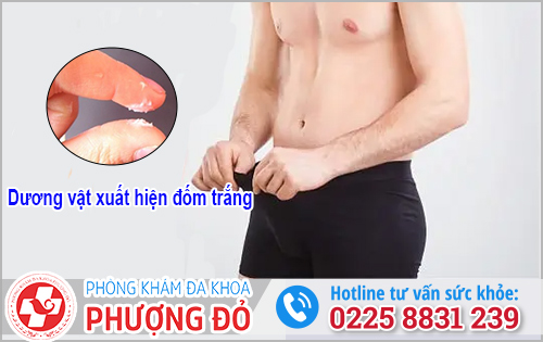 Dương vật xuất hiện đốm trắng