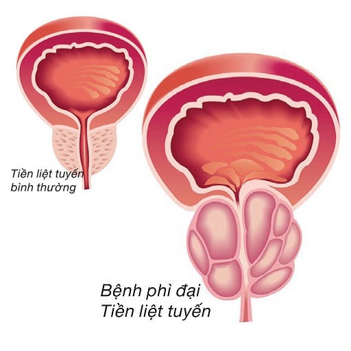 Phì đại tiền liệt tuyến uống thuốc gì để giảm kích thước khối u?