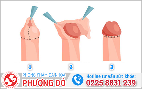 Quy trình cắt bao quy đầu