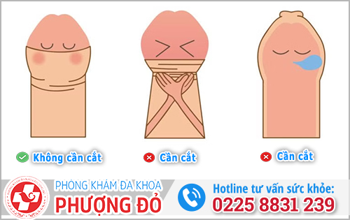 Khi nào nên cắt bao quy đầu?