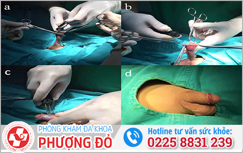 Quy trình phẫu thuật cắt bao quy đầu