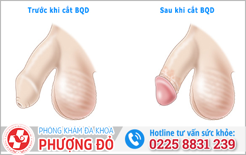 Cắt bao quy đầu có đau không?