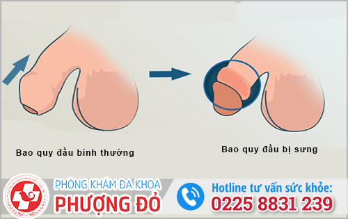 Vì sao nam giới bị sưng bao quy đầu?