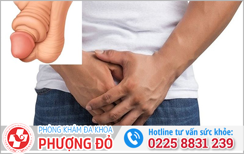 Bị sưng bao quy đầu sau khi quan hệ