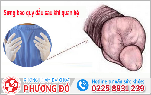 Chữa sưng bao quy đầu sau khi quan hệ