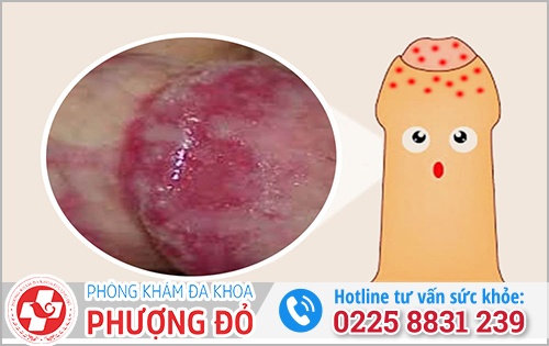 Bao quy đầu bị ngứa và sưng là do bệnh nấm candida
