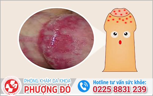Viêm bao quy đầu do thủ dâm