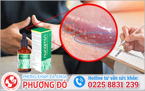 Thuốc chữa chuỗi hạt ngọc dương tại nhà