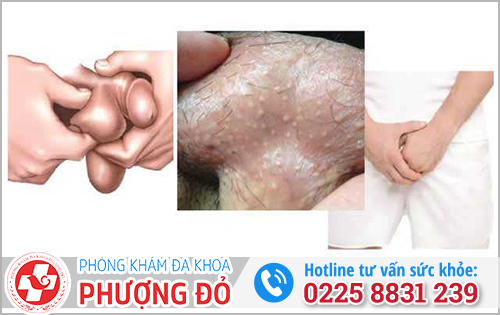Nguyên nhân gây ngứa bìu 