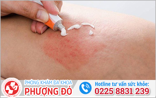 Lưu ý khi dùng thuốc bôi viêm bao quy đầu cho nam giới
