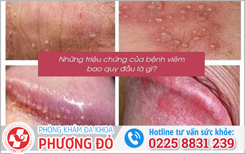 Biểu hiện viêm bao quy đầu
