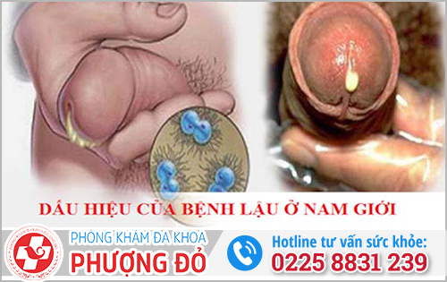 Tiểu buốt và ngứa ở nam giới có thể là bệnh lậu