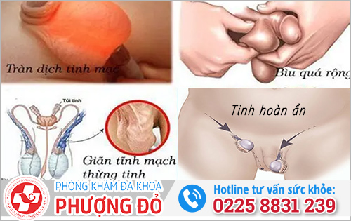 Tinh hoàn bên to bên nhỏ có nguy cơ mắc bệnh gì?