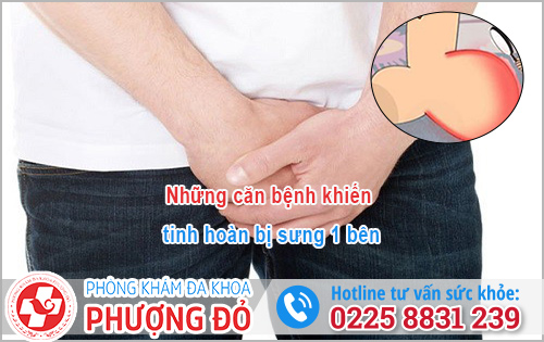 Tinh hoàn bị sưng 1 bên