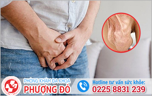 Tinh hoàn bị sưng đau 1 bên