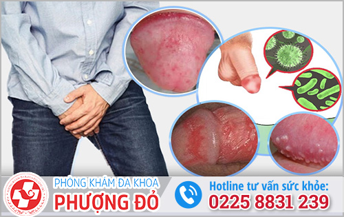 Viêm bao quy đầu là bệnh như thế nào?