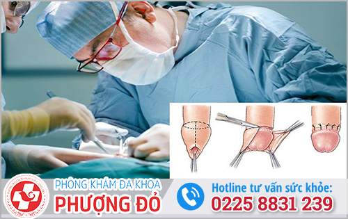 Chữa viêm bao quy đầu bằng phẫu thuật cắt bao quy đầu