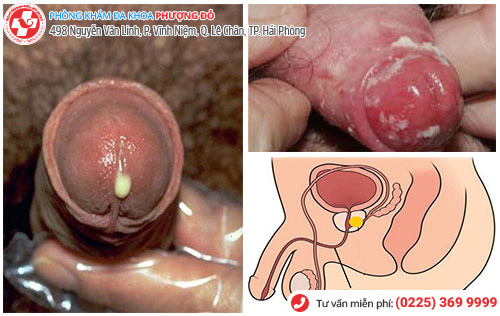 viêm nhiễm cơ quan sinh dục nam