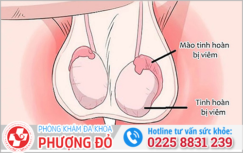 Viêm tinh hoàn bên phải có sao không?