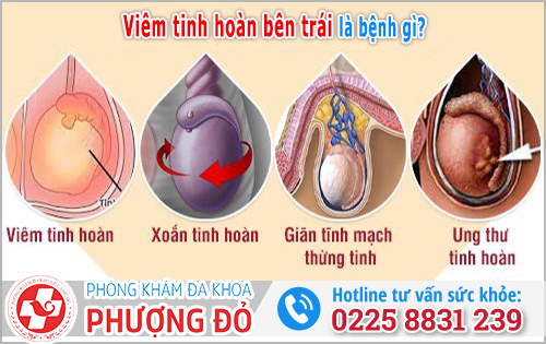 Viêm tinh hoàn bên trái là bệnh gì?