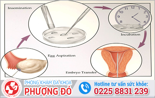 Can thiệp biện pháp hỗ trợ sinh sản