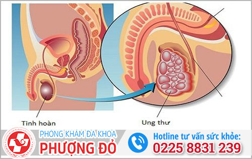 Nguyên nhân gây đau tinh hoàn và đau lưng