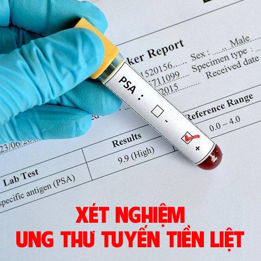 3 cách xét nghiệm ung thư tuyến tiền liệt cho kết quả chính xác nhất